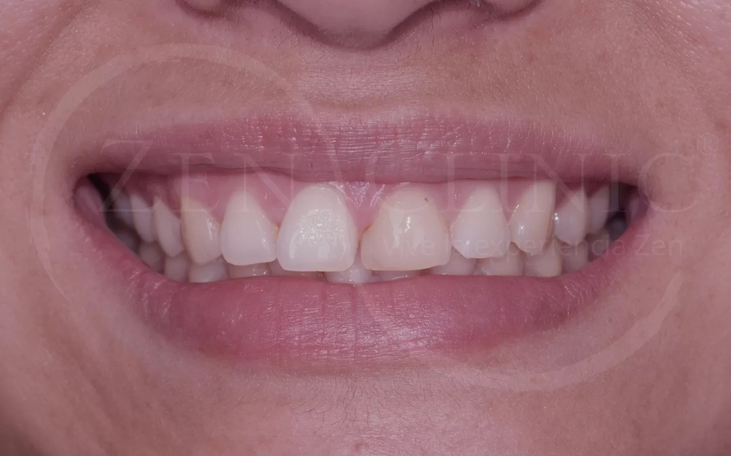 Antes